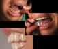 Clear Aligner - Implanty Gdańsk Dental Aesthetics Dr Adam Wolniewicz Gdańsk