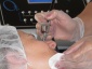 Oxybrazja - Lisse - Salon Kosmetyki Laserowej s.c. Łódź