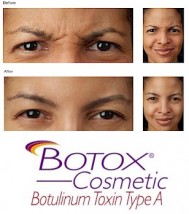 Botox- redukcja zmarszczek!!! - Gabinet Kosmetyki Profesjonalnej  Hebe  Mława