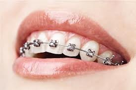 Aparaty stałe- System Damon - Libdent Gabinet Stomatologiczny Dentysta Ortodonta Stomatolog Ortodoncja System Damon Libiąż
