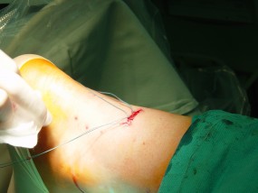Operacja małoinwazyjna uszkodzenia ścięgna Achillesa - Gabinet Ortopedyczny Miron Termanowski Toruń