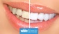 Skuteczne wybielanie zębów w 45 minut - White & Beauty laserowe wybielanie zębów Warszawa