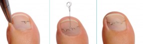 Korekcja wrastających paznokci za pomocą klamry metalowej - Gabinet Rehabilitacyjno Podologiczny w Sanoku Sanok