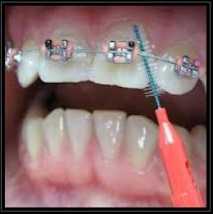 aparaty ortodontyczne - NZOZ Poradnia Stomatologiczna DM dentalceramic Dąbrowa Górnicza
