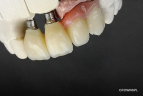 korony cyrkonowe na implantach - Laboratorium Dentystyczne M.Wieciech T.Augustyn sj. Wałbrzych