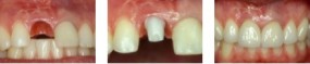 uzupełnianie braków zębów - NZOZ MEISSMED Przychodnia stomatologiczna Luboń