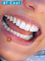 Wybielanie zębów - Niepubliczny Zakład Opieki Zdrowotnej Ars Dentica Szczecin