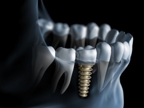 Implanty zębów - Czar Dent Centrum Implantologii i Stomatologii Estetycznej Białystok