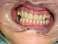 wykonastwo uzupełnień protetycznych Gdynia - Korona Dental - Pracownia protetyczna