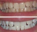 Zestaw do wybielania Zestaw do wybielania zębów - Działdowo C&J Sp. z o.o.  WhiteSmile21 