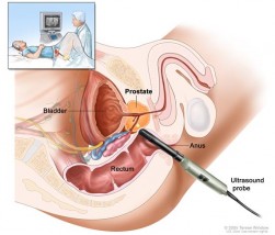 USG prostaty przezodbytnicze (TRUS) - Specjalistyczna Praktyka Lekarska Krzysztof Jop Specjalista Urolog Żory