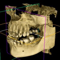 3D obrazowanie żuchwy i szczęki - NZOZ Stomatologia Bez Bólu Jelenia Góra