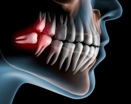Chirurgia stomatologiczna - usuwanie zębów, korzeni, - Stomatologia Kokoszczyk chirurg stomatolog Jarosław Kokoszczyk Oświęcim