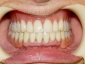 protetyka protezy szkieletowe akrylowe korony mosty - Grójec Kardent Pracownia Dentystyczna