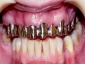 Kardent Pracownia Dentystyczna Grójec - protezy szkieletowe akrylowe korony mosty