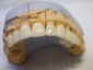 protezy szkieletowe akrylowe korony mosty protetyka - Grójec Kardent Pracownia Dentystyczna
