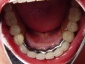 Grójec protezy szkieletowe akrylowe korony mosty - Kardent Pracownia Dentystyczna