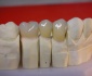 Kardent Pracownia Dentystyczna - protezy szkieletowe akrylowe korony mosty Grójec