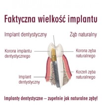 Praktyka Stomatologii Estetycznej lek dent Mirosław Szymonek Złotoryja - Implant stomatologiczny