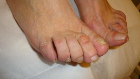 Pedicure medyczny Lubin, Legnica, Polkowice, Głogów - Specjalistyczny Gabinet Podologiczny TOPMED Martyna Bigaj Lubin