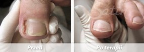 Wrastające paznokcie - klamry - Specjalistyczny Gabinet Podologiczny Legnica