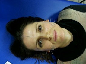 Akupunktura kosmetyczna - Akupunktura i Hirudoterapia - Anna Lofek Jaworzno