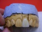 korony zębowe - Kardent Gabinet Stomatologiczny i Laboratorium Protetyki Dentystycznej Grójec