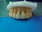 korony zębowe Grójec - Kardent Gabinet Stomatologiczny i Laboratorium Protetyki Dentystycznej