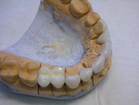 licówki - Kardent Gabinet Stomatologiczny i Laboratorium Protetyki Dentystycznej Grójec