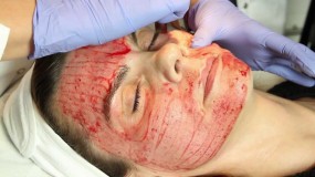 Mezoterapia DermaPen - Beautiful Health Salon Odnowy Biologicznej Zamość