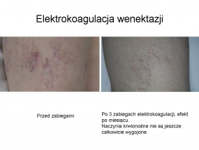 Elektrokoagulacja naczyń krwionośnych na nogach. - Kos&Kons kosmetyczny sklep internetowy AKADEMIA ESTETYKI Iwona Jabłońska Bełchatów