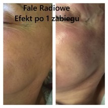 Zabiegi falami radiowymi - Salon Kosmetyczny Odnowa Agnieszka Kubica Łodygowice