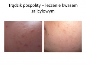 Oczyszczanie twarzy na kwasach - Beauty Lady - Gabinet Kosmetyki Nowoczesnej Edyta Trzcińska Lublin