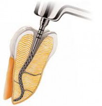 Leczenie kanałowe zęba z 3 kanałami - PureDent Gabinet Stomatologii Estetycznej i Ortodoncji Czeladź