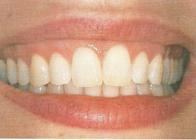 Licówki porcelanowe - DARA-DENT Specjalistyczny Gabinet Stomatologiczny lek. Stom - D. Zacharko-Kucharyk Wrocław