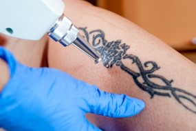 Usuwanie tatuażu, makijażu permanentnego - Swan Laser Clinic Sosnowiec