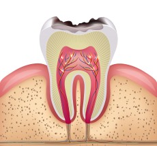 Leczenie biologiczne próchnicy głębokiej - Kukuryka Aleksandra lek. stomatolog. Praktyka dentystyczna. Poniatowa