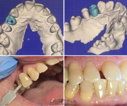 Protetyka - Dentina Anna Górska Tarnów - dentysta - protetyka- wybielanie zębów Tarnów