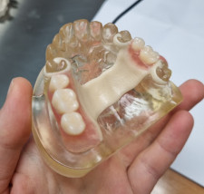 Protezy akronowe - Pracownia Techniki Dentystycznej Kolno
