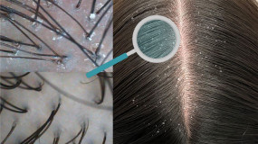 Peelingi skóry głowy - Trychomed Gabinet Trychologiczny Rozalia Bugara Pilawa