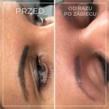 Laserowe usuwanie makijażu permanentnego - FADE AWAY - Studio laserowego usuwania tatuażu i makijażu permanentnego Łódź