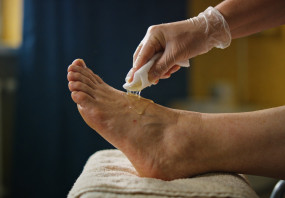 Leczenie stopy cukrzycowej - MEDICUS Agencja usług opiekuńczo – pielęgniarskich Gdańsk
