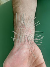 Terapia blizn - Manufaktura Zdrowia - Fizjoterapia - Masaż - Akupunktura Trąbki