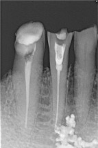 Zdjęcie RTG wewnątrzustne (punktowe) zęba - PRACOWNIA RTG  DAGAMED  Oświęcim