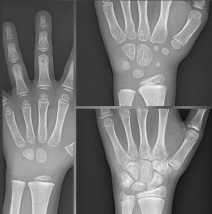 Zdjęcie RTG ręki / nadgarstka z oceną wieku kostnego - PRACOWNIA RTG  DAGAMED  Oświęcim
